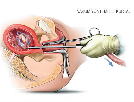 Kürtaj Nasıl Yapılır?
